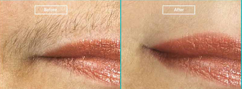 Laser Hair Removal - Dr. Rai Skin-VD-Leprosy Clinic